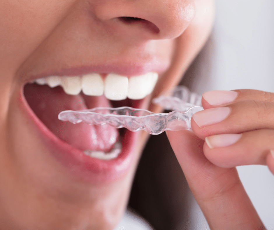 Teeth Straightening Charlotte - Adult Orthodontics - Invisalign